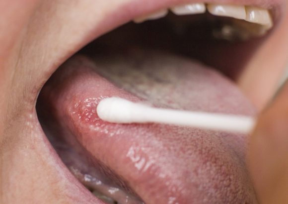 Brits have ‘extremely poor knowledge’ of oral cancer