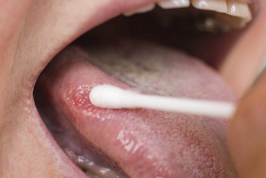 Brits have ‘extremely poor knowledge’ of oral cancer
